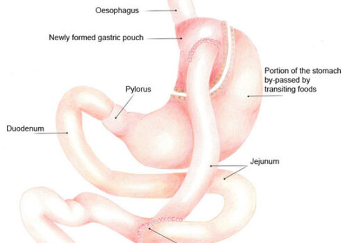 3 bypass